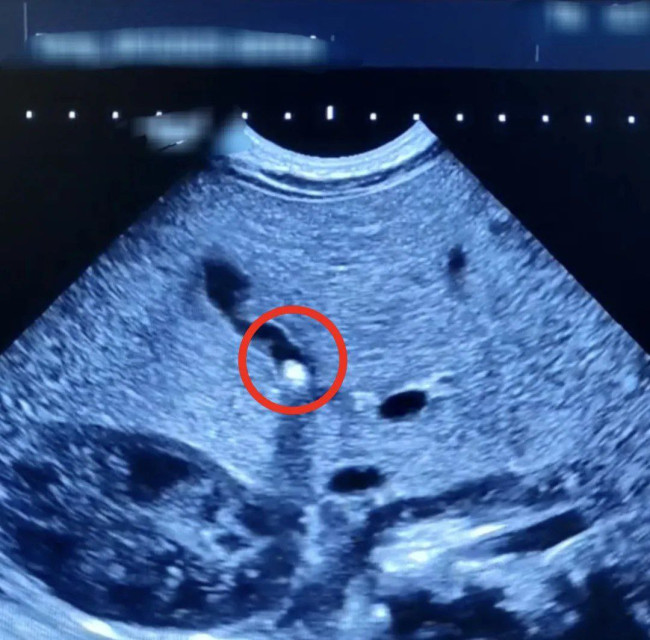 Камень в желчном пузыре у полуторагодовалого ребенка в Балакове