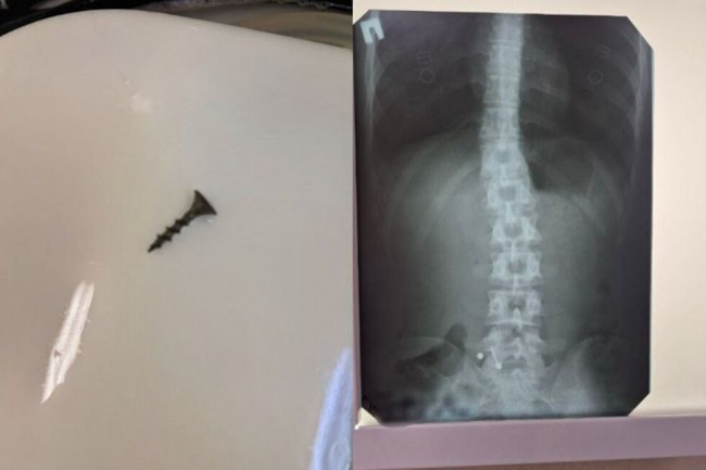 В Балакове два пациента попали в больницу с проглоченными предметами