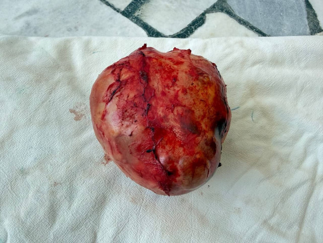 В Саратовской области у 52-летней женщины удалили эхинококковую кисту