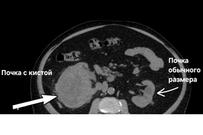 Медики Балаково спасли мужчину с воспалённой кистой почки