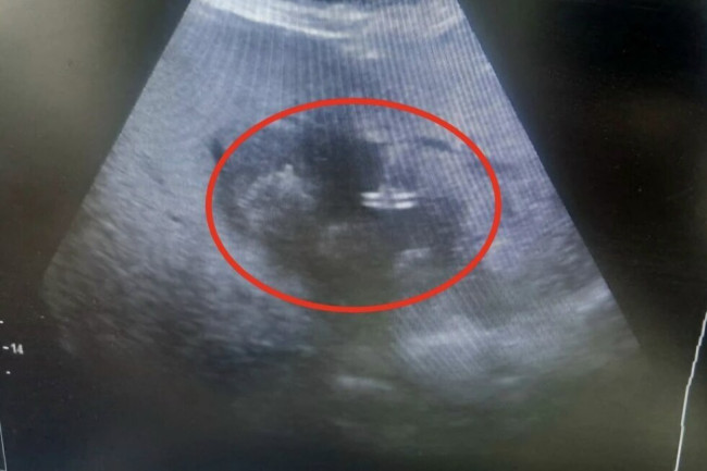 В Балаково врачи спасли пенсионерку с абсцессом печени