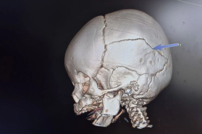 Санавиация доставила в Саратов 5-месячного малыша с переломом черепа