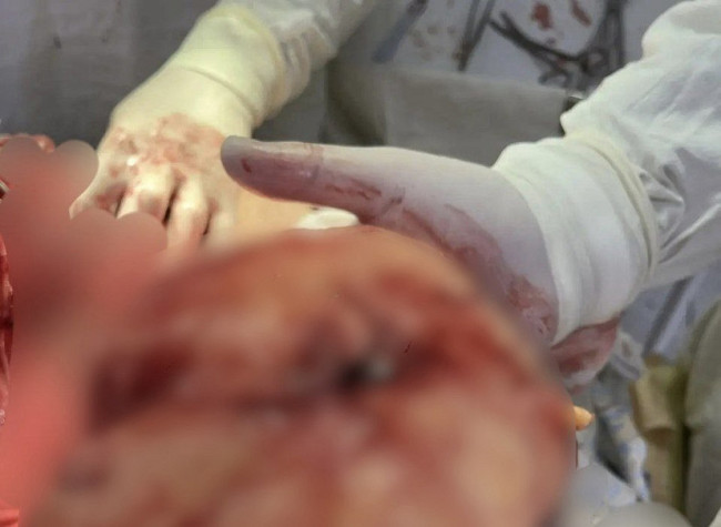 Хирурги Энгельсской больницы удалили липому у 70-летнего пациента