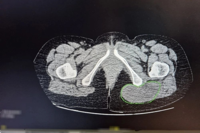Жительница Саратовской области заметила на ягодице маленький &laquo;жировик&raquo;, но пошла на массаж, а не к врачу