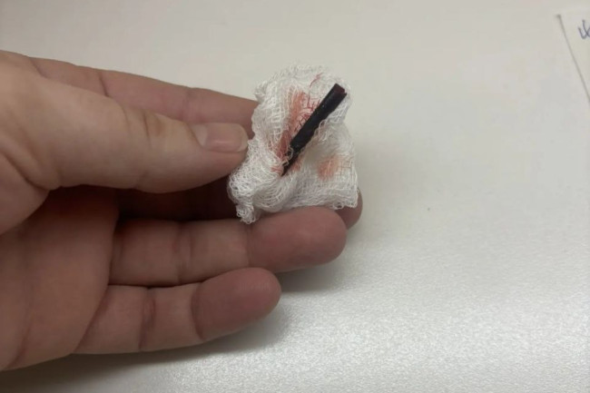 В Балакове врачи удалили щепку из руки 9-летнего мальчика